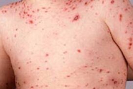 chickenpox parties