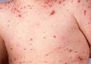 chickenpox parties