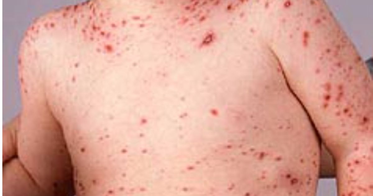 chickenpox parties